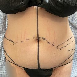 Tummy Tuck Before & After Patient #928