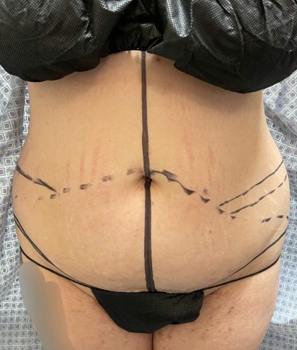 Tummy Tuck Before & After Patient #928