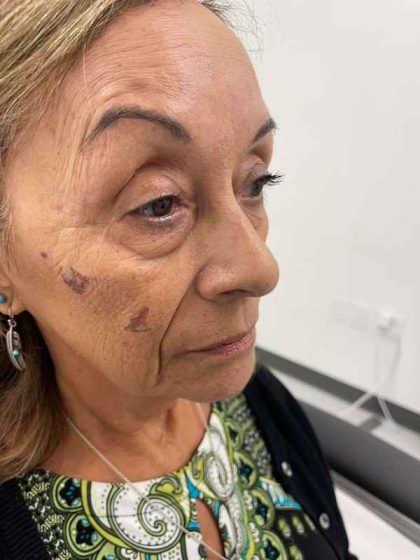 Botox Before & After Patient #552