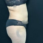 Liposuction Before & After Patient #761