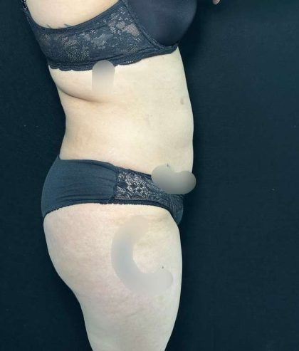 Liposuction Before & After Patient #761
