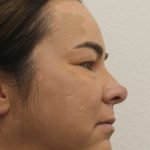 Eyelid Lift Before & After Patient #632