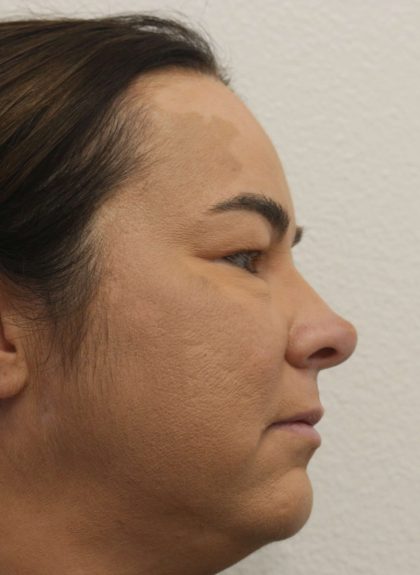 Eyelid Lift Before & After Patient #632