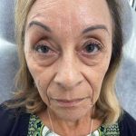 Botox Before & After Patient #552