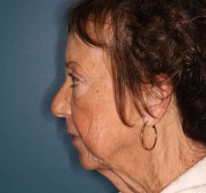 Facelift Before & After Patient #596