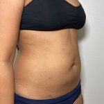 Liposuction Before & After Patient #858