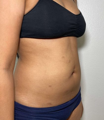 Liposuction Before & After Patient #858