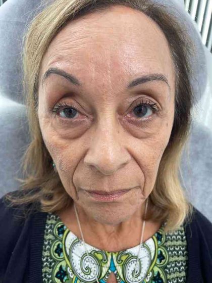 Botox Before & After Patient #552