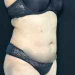 Liposuction Before & After Patient #761