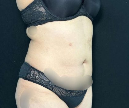 Liposuction Before & After Patient #761