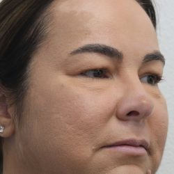 Eyelid Lift Before & After Patient #632