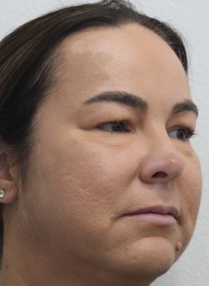 Eyelid Lift Before & After Patient #632