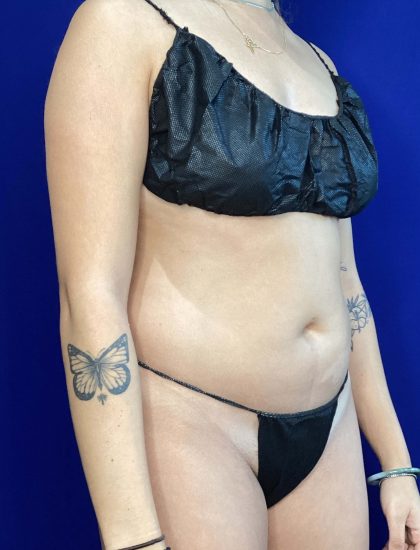 Liposuction Before & After Patient #822