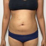 Liposuction Before & After Patient #858