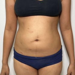 Liposuction Before & After Patient #858