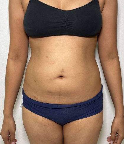 Liposuction Before & After Patient #858