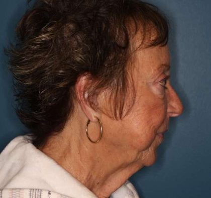 Facelift Before & After Patient #596