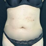 Liposuction Before & After Patient #761