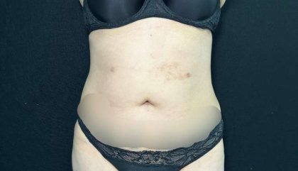 Liposuction Before & After Patient #761