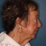 Facelift Before & After Patient #596