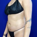 Liposuction Before & After Patient #822