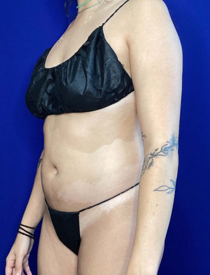 Liposuction Before & After Patient #822
