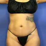 Liposuction Before & After Patient #833