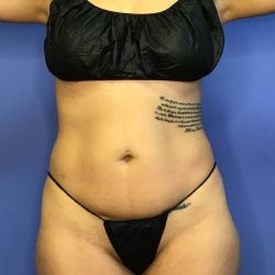 Liposuction Before & After Patient #833
