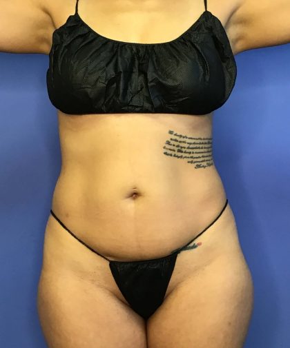 Liposuction Before & After Patient #833