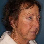 Facelift Before & After Patient #596