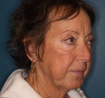 Facelift Before & After Patient #596
