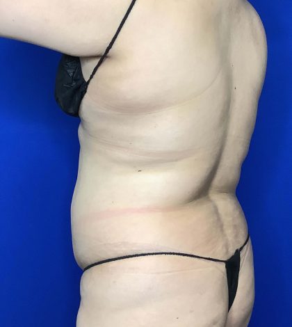 Liposuction Before & After Patient #809