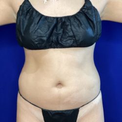 Liposuction Before & After Patient #822