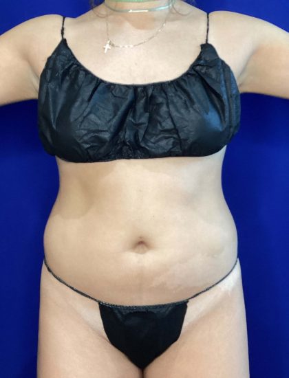 Liposuction Before & After Patient #822