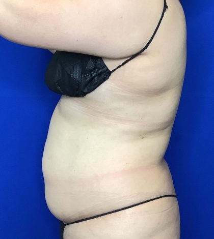 Liposuction Before & After Patient #809