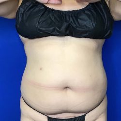 Liposuction Before & After Patient #809