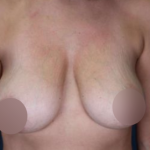 Breast Lift Before & After Patient #739