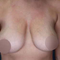 Breast Lift Before & After Patient #739