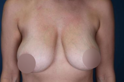 Breast Lift Before & After Patient #739