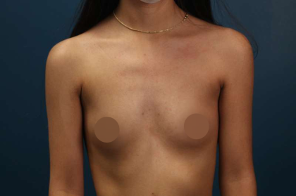 Breast Augmentation Before & After Patient #682