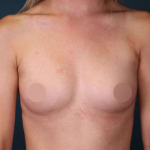 Breast Augmentation Before & After Patient #700