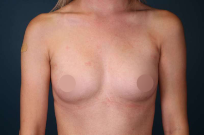 Breast Augmentation Before & After Patient #700