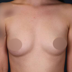 Breast Augmentation Before & After Patient #706