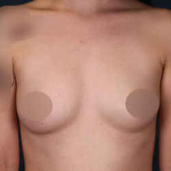 Breast Augmentation Before & After Patient #706