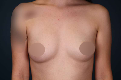 Breast Augmentation Before & After Patient #706