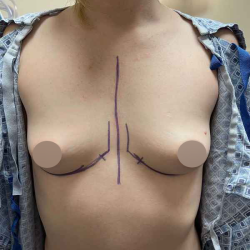 Breast Augmentation Before & After Patient #709