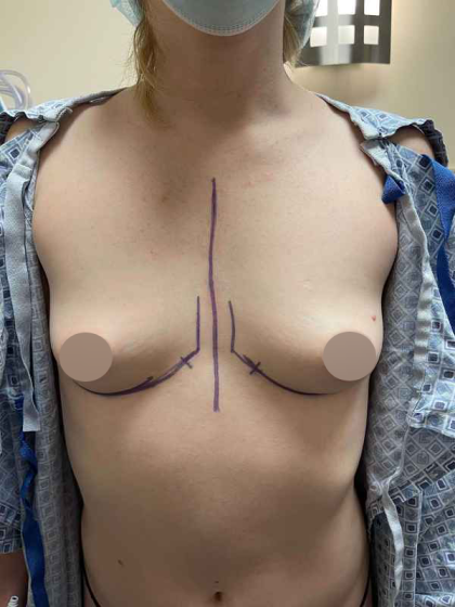 Breast Augmentation Before & After Patient #709