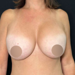 Breast Lift Before & After Patient #715