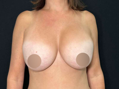 Breast Lift Before & After Patient #715