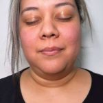 Chin Lipo Before & After Patient #779
